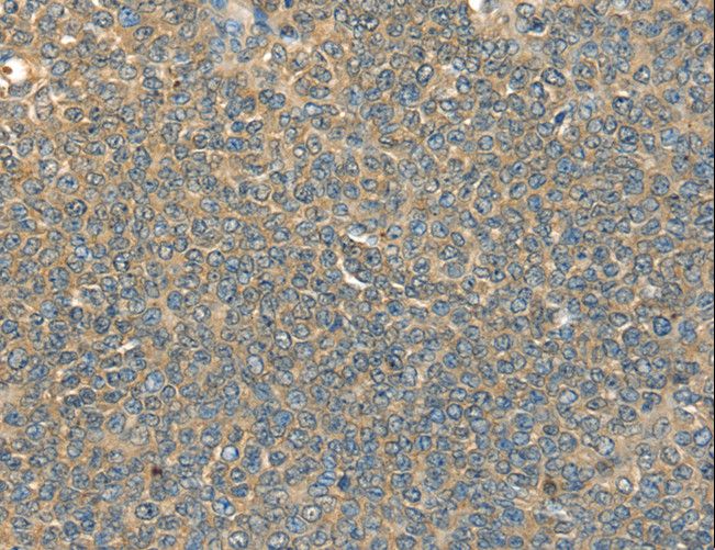 DHCR24 / Seladin-1 Antibody - Immunohistochemistry of paraffin-embedded Human ovarian cancer using DHCR24 Polyclonal Antibody at dilution of 1:40.