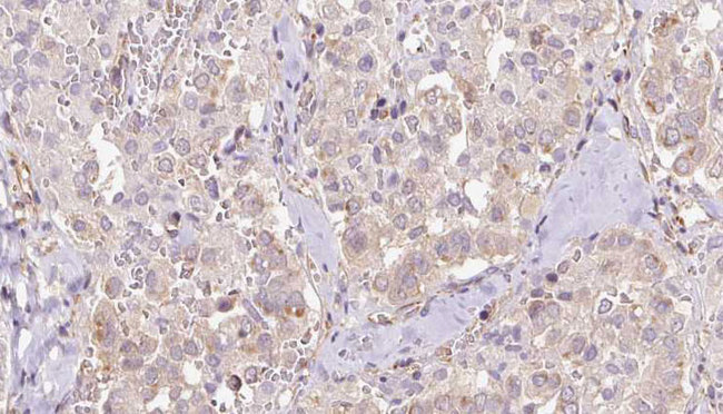 DHCR24 / Seladin-1 Antibody - 1:100 staining human thyroid carcinoma tissue by IHC-P. The sample was formaldehyde fixed and a heat mediated antigen retrieval step in citrate buffer was performed. The sample was then blocked and incubated with the antibody for 1.5 hours at 22°C. An HRP conjugated goat anti-rabbit antibody was used as the secondary.