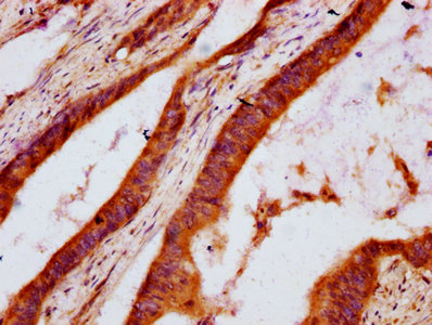 DHCR7 Antibody - Immunohistochemistry Dilution at 1:600 and staining in paraffin-embedded human colon cancer performed on a Leica BondTM system. After dewaxing and hydration, antigen retrieval was mediated by high pressure in a citrate buffer (pH 6.0). Section was blocked with 10% normal Goat serum 30min at RT. Then primary antibody (1% BSA) was incubated at 4°C overnight. The primary is detected by a biotinylated Secondary antibody and visualized using an HRP conjugated SP system.