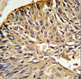 DHFR Antibody - DHFR Antibody IHC of formalin-fixed and paraffin-embedded human lung carcinoma followed by peroxidase-conjugated secondary antibody and DAB staining.
