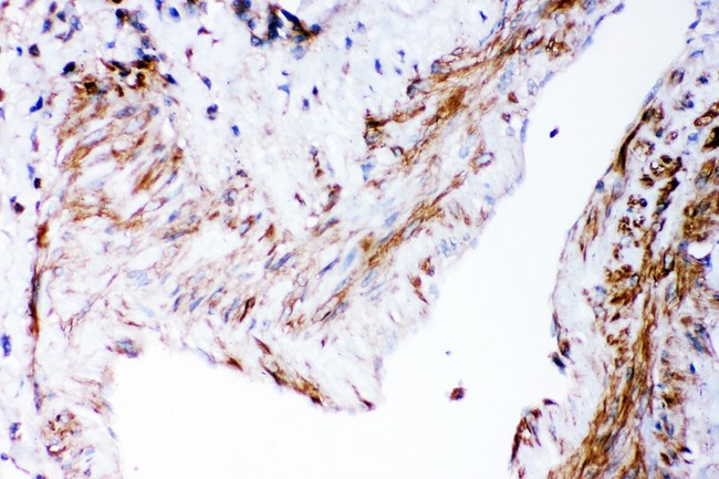 DHFR Antibody - DHFR antibody IHC-paraffin: Human Lung Cancer Tissue.