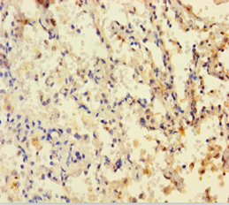 DHFR Antibody - Immunohistochemistry of paraffin-embedded human lung cancer using DHFR Antibody at dilution of 1:100