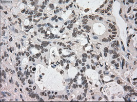 DHFR Antibody - IHC of paraffin-embedded Adenocarcinoma of colon tissue using anti-DHFR mouse monoclonal antibody. (Dilution 1:50).