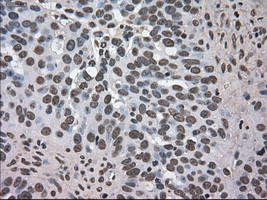 DHFR Antibody - IHC of paraffin-embedded Adenocarcinoma of ovary tissue using anti-DHFR mouse monoclonal antibody. (Dilution 1:50).