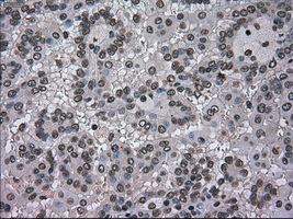 DHFR Antibody - IHC of paraffin-embedded Carcinoma of kidney tissue using anti-DHFR mouse monoclonal antibody. (Dilution 1:50).