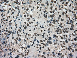 DHFR Antibody - IHC of paraffin-embedded Carcinoma of bladder tissue using anti-DHFR mouse monoclonal antibody. (Dilution 1:50).