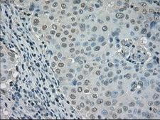 DHFR Antibody - IHC of paraffin-embedded Adenocarcinoma of breast tissue using anti-DHFR mouse monoclonal antibody. (Dilution 1:50).