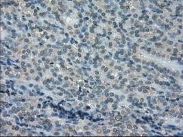 DHFR Antibody - IHC of paraffin-embedded Carcinoma of thyroid tissue using anti-DHFR mouse monoclonal antibody. (Dilution 1:50).