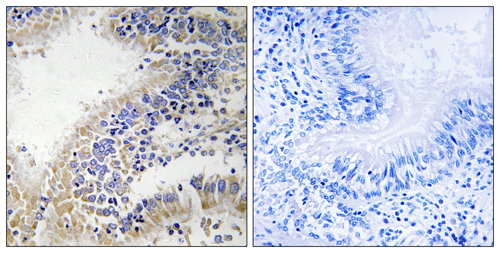 DHODH Antibody - Immunohistochemistry analysis of paraffin-embedded human breast carcinoma tissue, using DHODH Antibody. The picture on the right is blocked with the synthesized peptide.