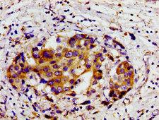 DHODH Antibody - Immunohistochemistry image of paraffin-embedded human breast cancer at a dilution of 1:100
