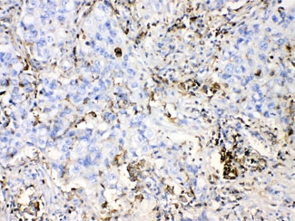 DHODH Antibody - IHC testing of FFPE human lung cancer tissue with DHODH antibody at 1ug/ml. HIER: steam section in pH6 citrate buffer for 20 min.