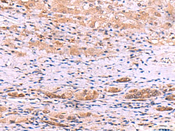 DHPS Antibody - Immunohistochemistry of paraffin-embedded Human liver cancer tissue  using DHPS Polyclonal Antibody at dilution of 1:55(×200)
