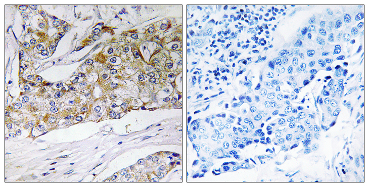 DHRS11 / MGC4172 Antibody - Immunohistochemistry analysis of paraffin-embedded human breast carcinoma tissue, using DHRS11 Antibody. The picture on the right is blocked with the synthesized peptide.