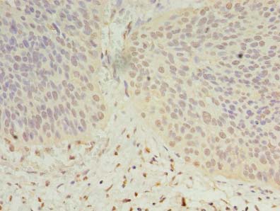 DHRS12 Antibody - Immunohistochemistry of paraffin-embedded human cervical cancer using antibody at dilution of 1:100.