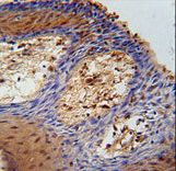 DHRS2 / HEP27 Antibody - DHRS2 Antibody immunohistochemistry of formalin-fixed and paraffin-embedded human skin carcinoma followed by peroxidase-conjugated secondary antibody and DAB staining.