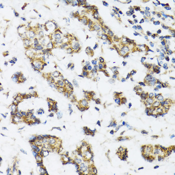 DHRS2 / HEP27 Antibody - Immunohistochemistry of paraffin-embedded human breast cancer tissue.