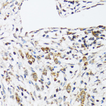 DHRS2 / HEP27 Antibody - Immunohistochemistry of paraffin-embedded human uterine cancer tissue.