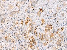 DHRS2 / HEP27 Antibody - Immunohistochemistry of paraffin-embedded Human liver cancer tissue  using DHRS2 Polyclonal Antibody at dilution of 1:50(×200)