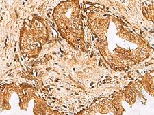 DHRS2 / HEP27 Antibody - Immunohistochemistry of paraffin-embedded Human prost at e cancer tissue  using DHRS2 Polyclonal Antibody at dilution of 1:55(×200)