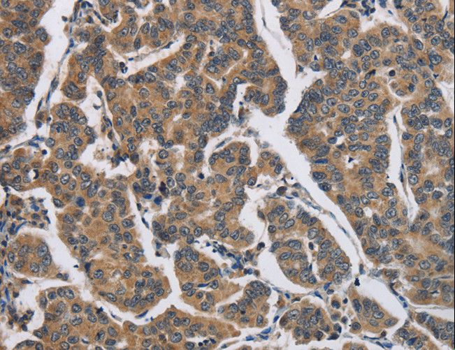 DHRS3 / SDR1 Antibody - Immunohistochemistry of paraffin-embedded Human breast cancer using DHRS3 Polyclonal Antibody at dilution of 1:30.