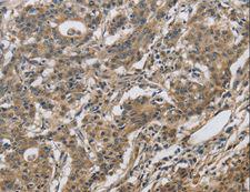DHRS3 / SDR1 Antibody - Immunohistochemistry of paraffin-embedded Human gastric cancer using DHRS3 Polyclonal Antibody at dilution of 1:30.