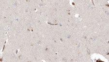 DHRS3 / SDR1 Antibody - 1:100 staining human brain carcinoma tissue by IHC-P. The sample was formaldehyde fixed and a heat mediated antigen retrieval step in citrate buffer was performed. The sample was then blocked and incubated with the antibody for 1.5 hours at 22°C. An HRP conjugated goat anti-rabbit antibody was used as the secondary.