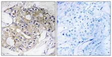 DHRS4 / PSCD Antibody - Immunohistochemistry analysis of paraffin-embedded human breast carcinoma tissue, using DHRS4 Antibody. The picture on the right is blocked with the synthesized peptide.