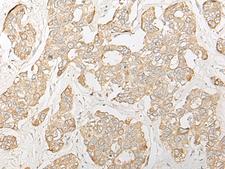 DHRS7 Antibody - Immunohistochemistry of paraffin-embedded Human liver cancer tissue  using DHRS7 Polyclonal Antibody at dilution of 1:30(×200)