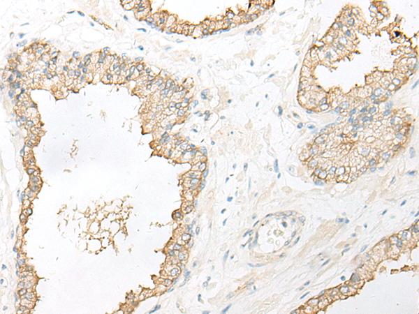DHRS7 Antibody - Immunohistochemistry of paraffin-embedded Human prost ate cancer tissue  using DHRS7 Polyclonal Antibody at dilution of 1:30(×200)