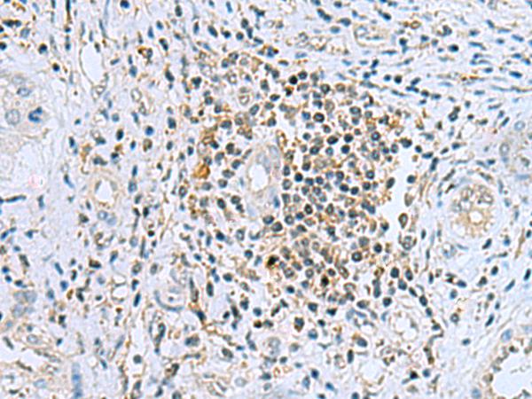 DHRS7B Antibody - Immunohistochemistry of paraffin-embedded Human liver cancer tissue  using DHRS7B Polyclonal Antibody at dilution of 1:80(×200)