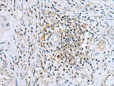 DHRS7B Antibody - Immunohistochemistry of paraffin-embedded Human liver cancer tissue  using DHRS7B Polyclonal Antibody at dilution of 1:80(×200)