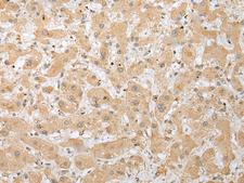 DHRSX Antibody - Immunohistochemistry of paraffin-embedded Human liver cancer tissue  using DHRSX Polyclonal Antibody at dilution of 1:30(×200)