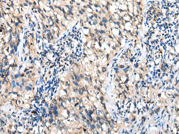 DHRSX Antibody - Immunohistochemistry of paraffin-embedded Human lung cancer tissue  using DHRSX Polyclonal Antibody at dilution of 1:30(×200)