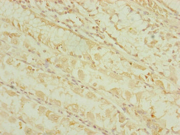 DHTKD1 Antibody - Immunohistochemistry of paraffin-embedded human gastric cancer at dilution of 1:100