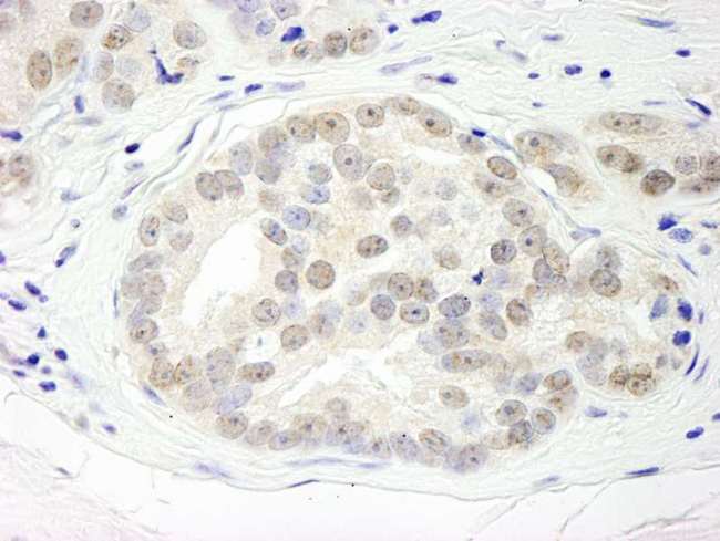 DHX15 Antibody - Detection of Human DHX15 by Immunohistochemistry. Sample: FFPE section of human prostate carcinoma. Antibody: Affinity purified rabbit anti-DHX15 used at a dilution of 1:1000 (1 ug/ml). Detection: DAB.