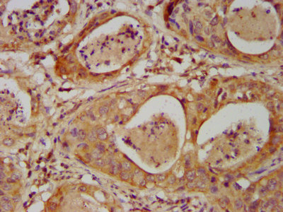 DHX34 Antibody - Immunohistochemistry image at a dilution of 1:500 and staining in paraffin-embedded human cervical cancer performed on a Leica BondTM system. After dewaxing and hydration, antigen retrieval was mediated by high pressure in a citrate buffer (pH 6.0) . Section was blocked with 10% normal goat serum 30min at RT. Then primary antibody (1% BSA) was incubated at 4 °C overnight. The primary is detected by a biotinylated secondary antibody and visualized using an HRP conjugated SP system.