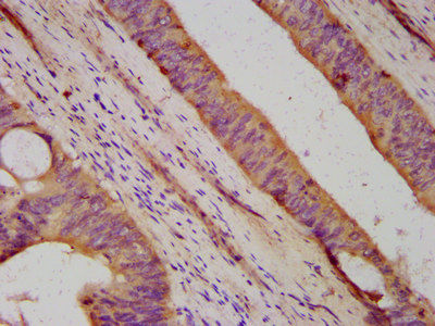 DHX34 Antibody - Immunohistochemistry image at a dilution of 1:500 and staining in paraffin-embedded human colon cancer performed on a Leica BondTM system. After dewaxing and hydration, antigen retrieval was mediated by high pressure in a citrate buffer (pH 6.0) . Section was blocked with 10% normal goat serum 30min at RT. Then primary antibody (1% BSA) was incubated at 4 °C overnight. The primary is detected by a biotinylated secondary antibody and visualized using an HRP conjugated SP system.