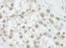 DHX36 Antibody - Detection of Human DHX36 by Immunohistochemistry. Sample: FFPE section of human testicular seminoma. Antibody: Affinity purified rabbit anti-DHX36 used at a dilution of 1:1000 (1 ug/ml). Detection: DAB.