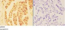 DHX36 Antibody - Immunohistochemistry (IHC) analysis of DHX36 antibody in paraffin-embedded human breast carcinoma tissue at 1:50, showing cytoplasm and nucleus staining. Negative control (the right) using PBS instead of primary antibody. Secondary antibody is Goat Anti-Rabbit Ig.