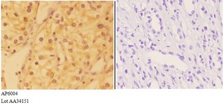 DHX36 Antibody - Immunohistochemistry (IHC) analysis of DHX36 antibody in paraffin-embedded human kidney carcinoma tissue at 1:50, showing cytoplasm and nucleus staining. Negative control (the right) using PBS instead of primary antibody. Secondary antibody is Goat Anti-Rabbit Ig.
