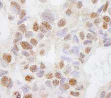DHX38 Antibody - Detection of Human DHX38 by Immunohistochemistry. Sample: FFPE section of human breast carcinoma. Antibody: Affinity purified rabbit anti-DHX38 used at a dilution of 1:250.