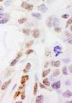 DHX38 Antibody - Detection of Human DHX38 by Immunohistochemistry. Sample: FFPE section of human breast carcinoma. Antibody: Affinity purified rabbit anti-DHX38 used at a dilution of 1:1000 (1 ug/ml). Detection: DAB.