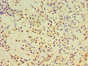 DHX58 / LGP2 Antibody - Immunohistochemistry of paraffin-embedded human breast cancer using antibody at 1:100 dilution.