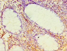 DHX58 / LGP2 Antibody - Immunohistochemistry of paraffin-embedded human colon cancer using antibody at 1:100 dilution.
