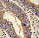 DHX58 / LGP2 Antibody - DHX58 Antibody immunohistochemistry of formalin-fixed and paraffin-embedded human colon carcinoma followed by peroxidase-conjugated secondary antibody and DAB staining.