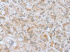 DHX58 / LGP2 Antibody - Immunohistochemistry of paraffin-embedded Human liver cancer tissue  using DHX58 Polyclonal Antibody at dilution of 1:60(×200)