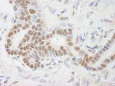 DHX9 Antibody - Detection of Human DHX9 by Immunohistochemistry. Sample: FFPE section of human stomach adenocarcinoma. Antibody: Affinity purified rabbit anti-DHX9 used at a dilution of 1:250.