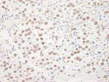 DHX9 Antibody - Detection of Human DHX9 by Immunohistochemistry. Sample: FFPE section of human testicular seminoma. Antibody: Affinity purified rabbit anti-DHX9 used at a dilution of 1:200 (1 ug/ml). Detection: DAB.