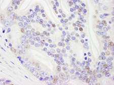 DHX9 Antibody - Detection of Human DHX9 by Immunohistochemistry. Sample: FFPE section of human prostate carcinoma. Antibody: Affinity purified rabbit anti-DHX9 used at a dilution of 1:1000 (0.2 ug/ml). Detection: DAB.