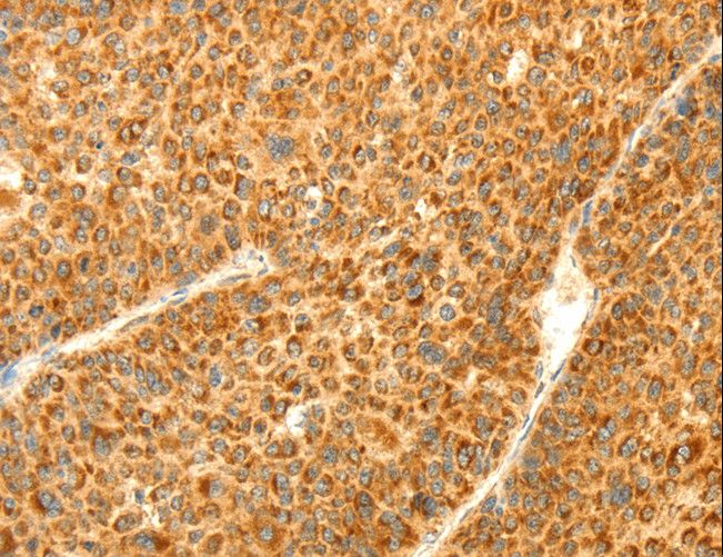 DIABLO / SMAC Antibody - Immunohistochemistry of paraffin-embedded Human liver cancer using DIABLO Polyclonal Antibody at dilution of 1:70.